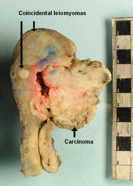Uterus with endometrial adenocarcinoma