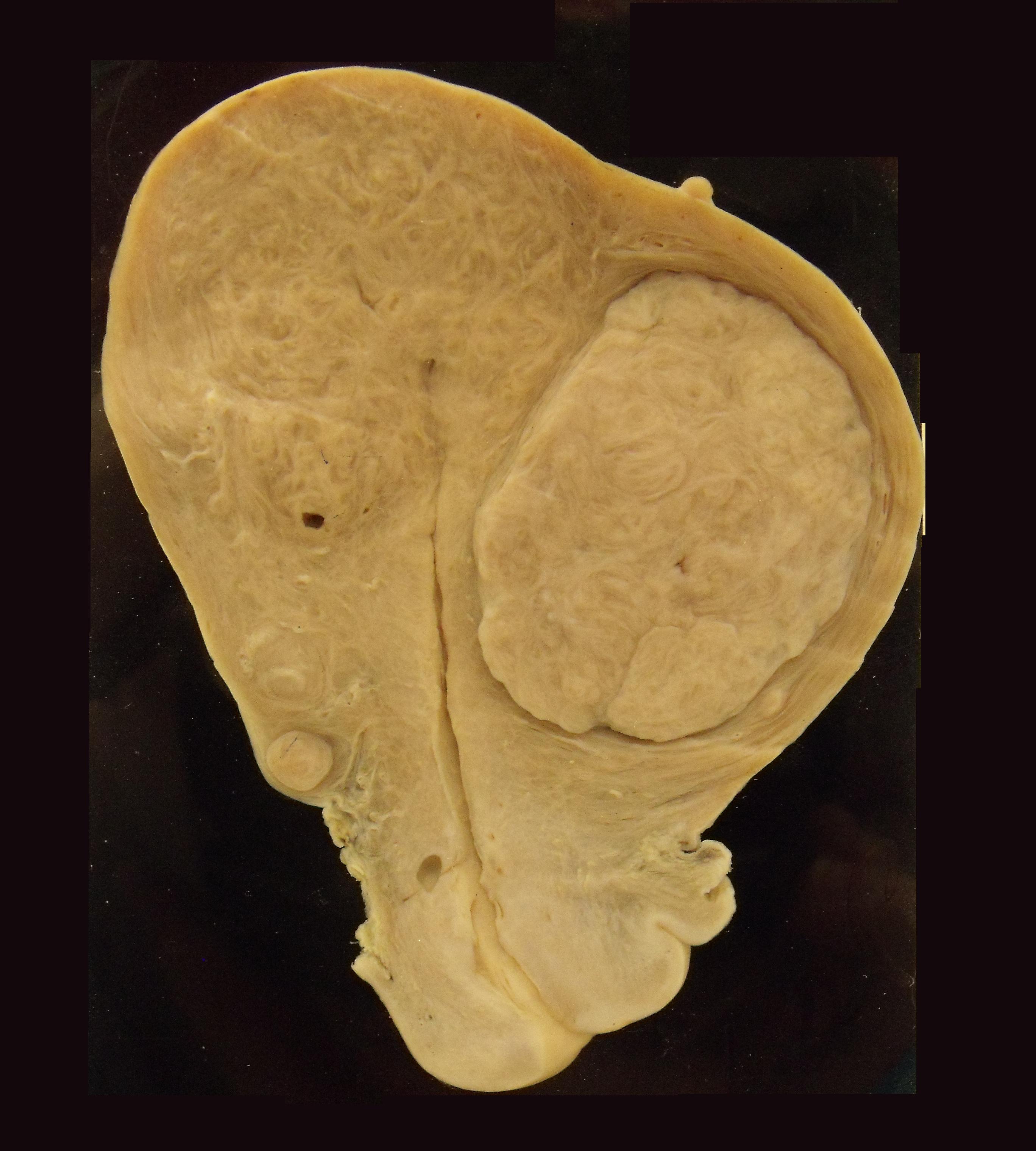 Adenomyosis