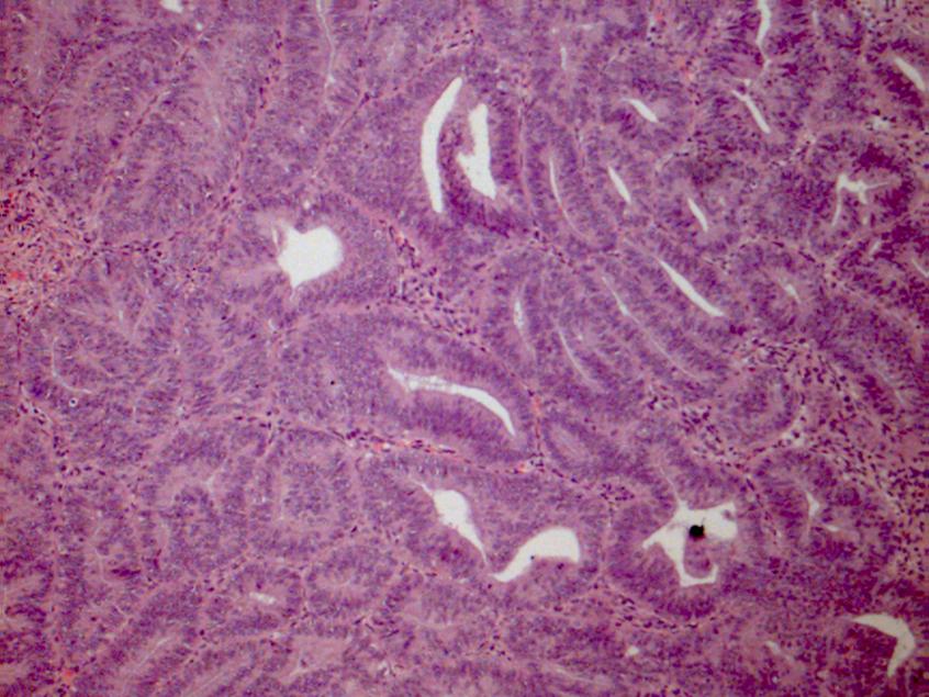Microscopy of endometrioid endometrial adenocarcinoma
