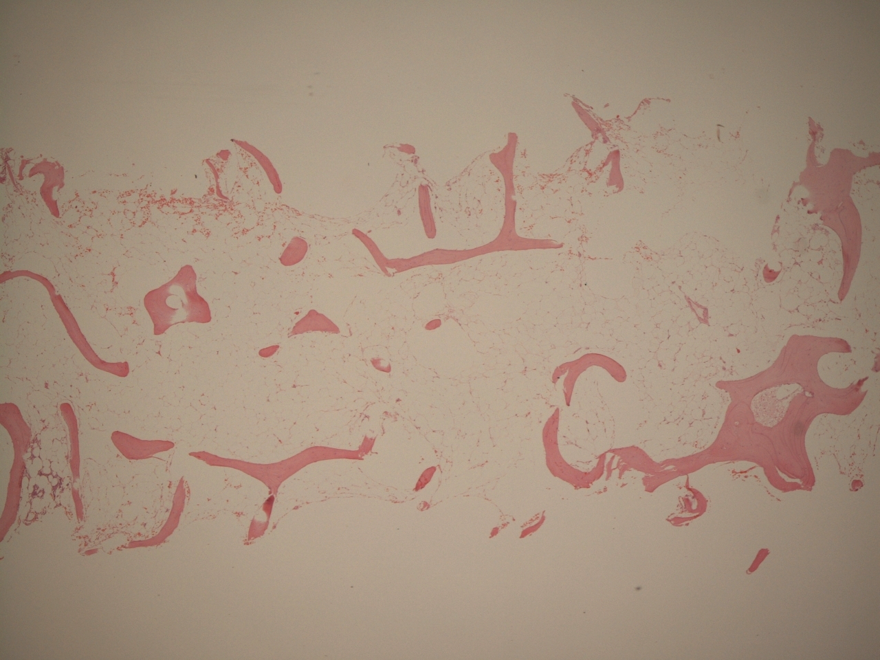 Aplastic anaemia