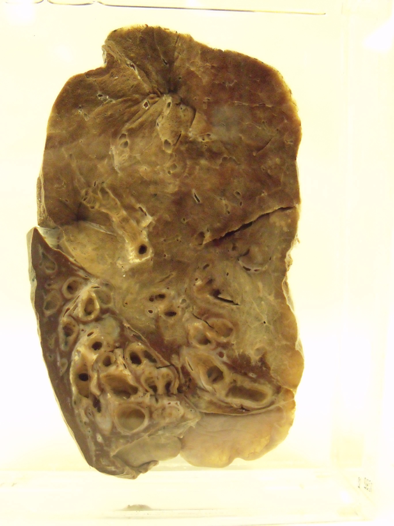 Bronchiectasis