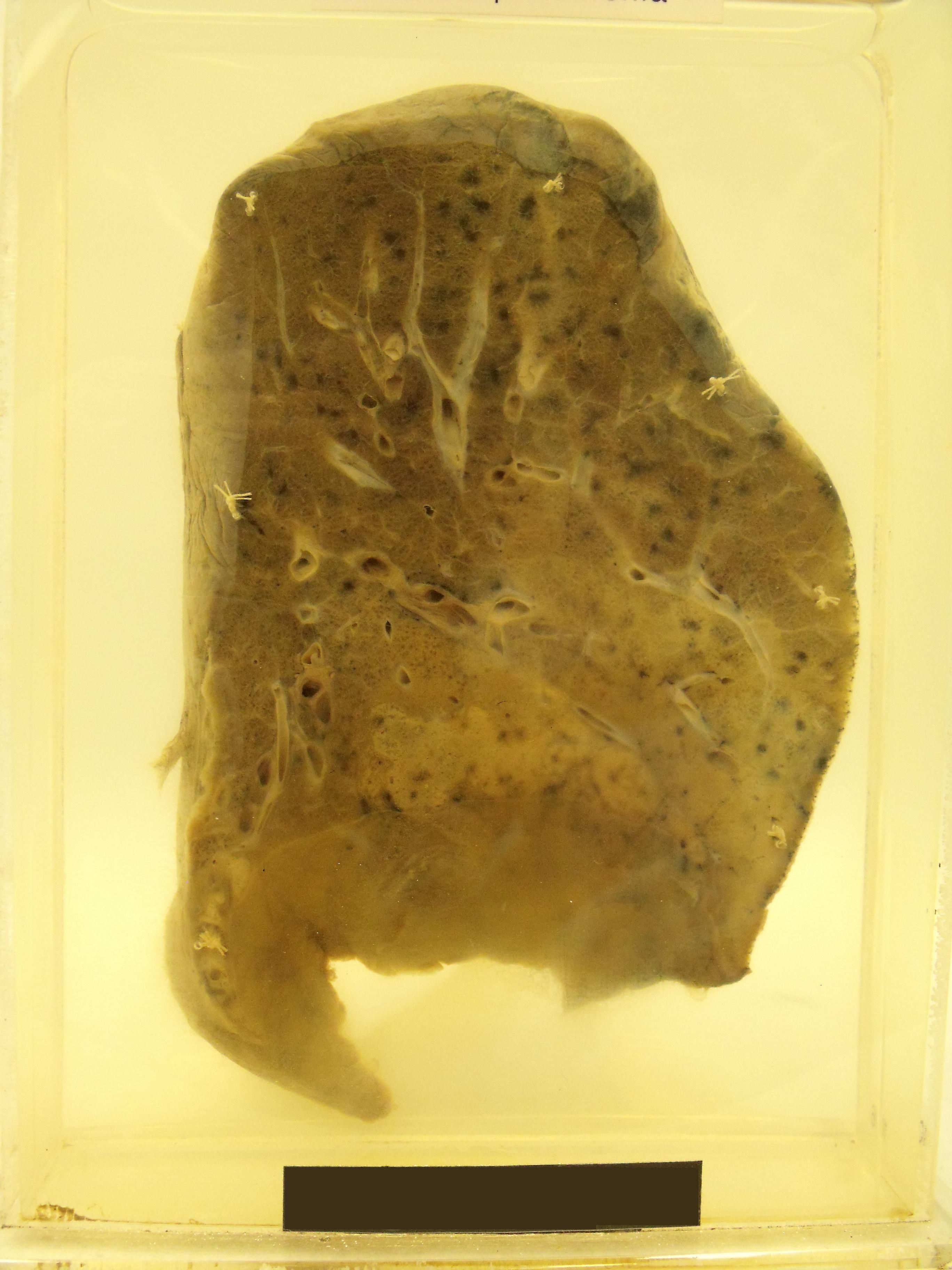 Bronchopneumonia