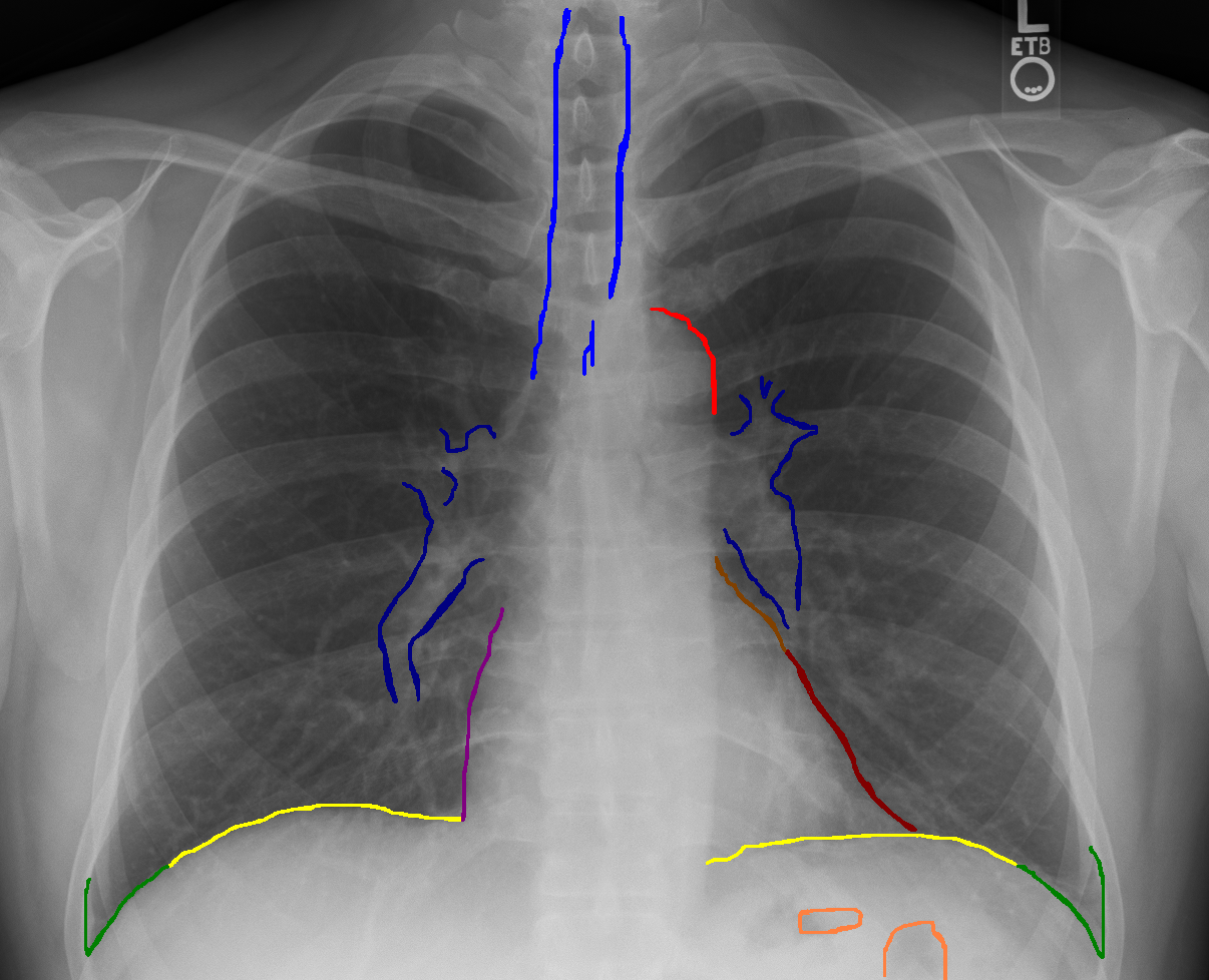 Chest X-ray