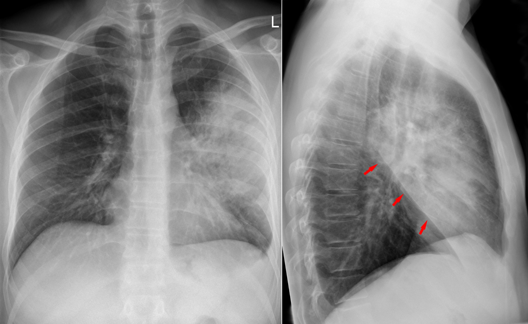 Left upper lobe pneumonia