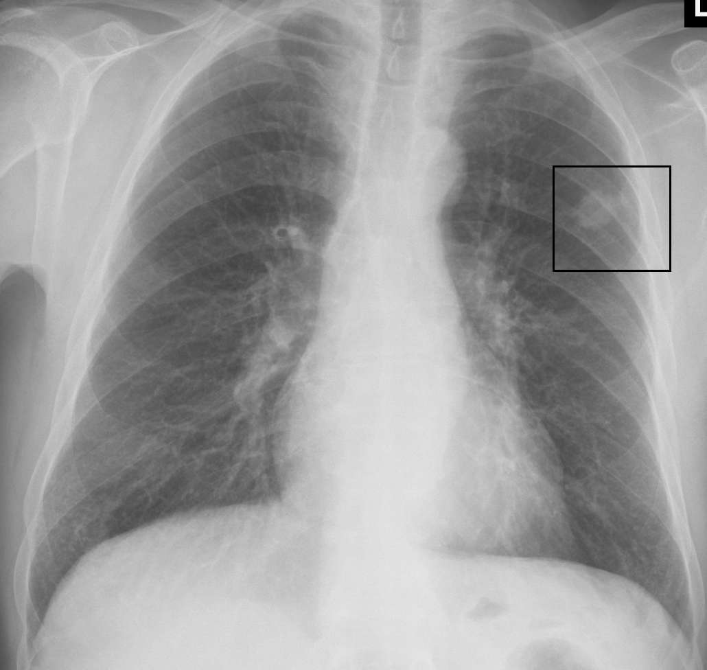 Chest X-ray of bronchial carcinoma