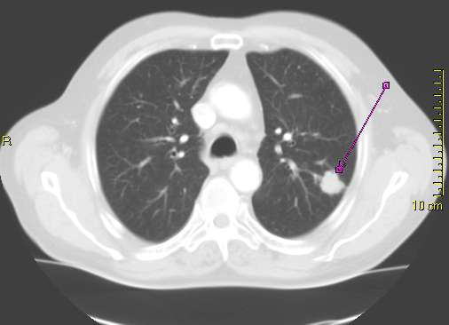 Chest X-ray of bronchial carcinoma