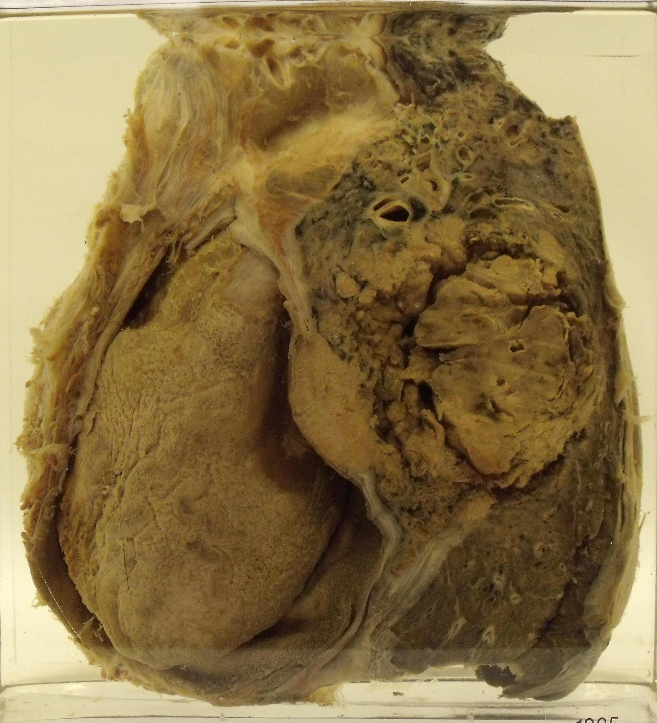 Bronchial carcinoma