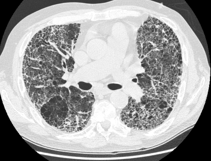 Chest X-ray of pulmonary fibrosis