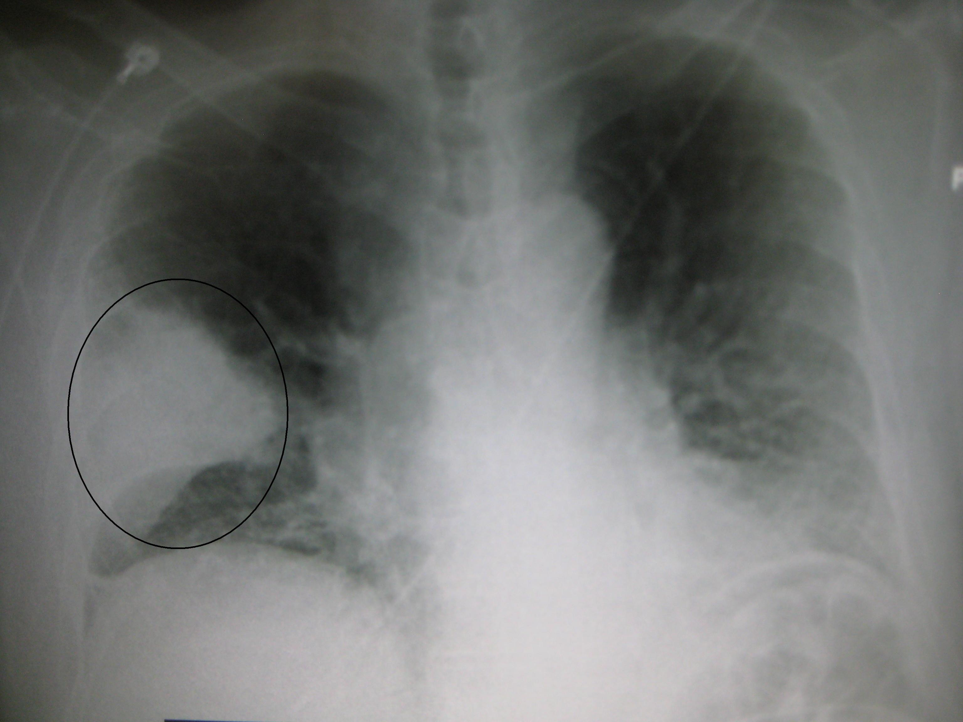 Right middle lobe pneumonia