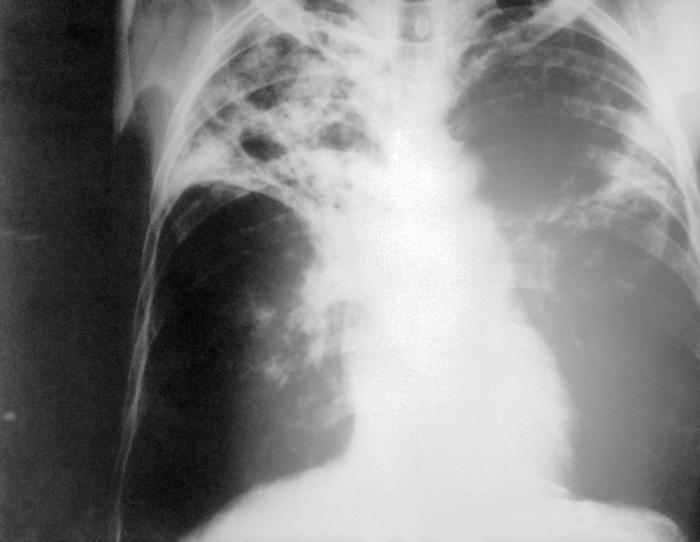 Chest X-ray of tuberculosis