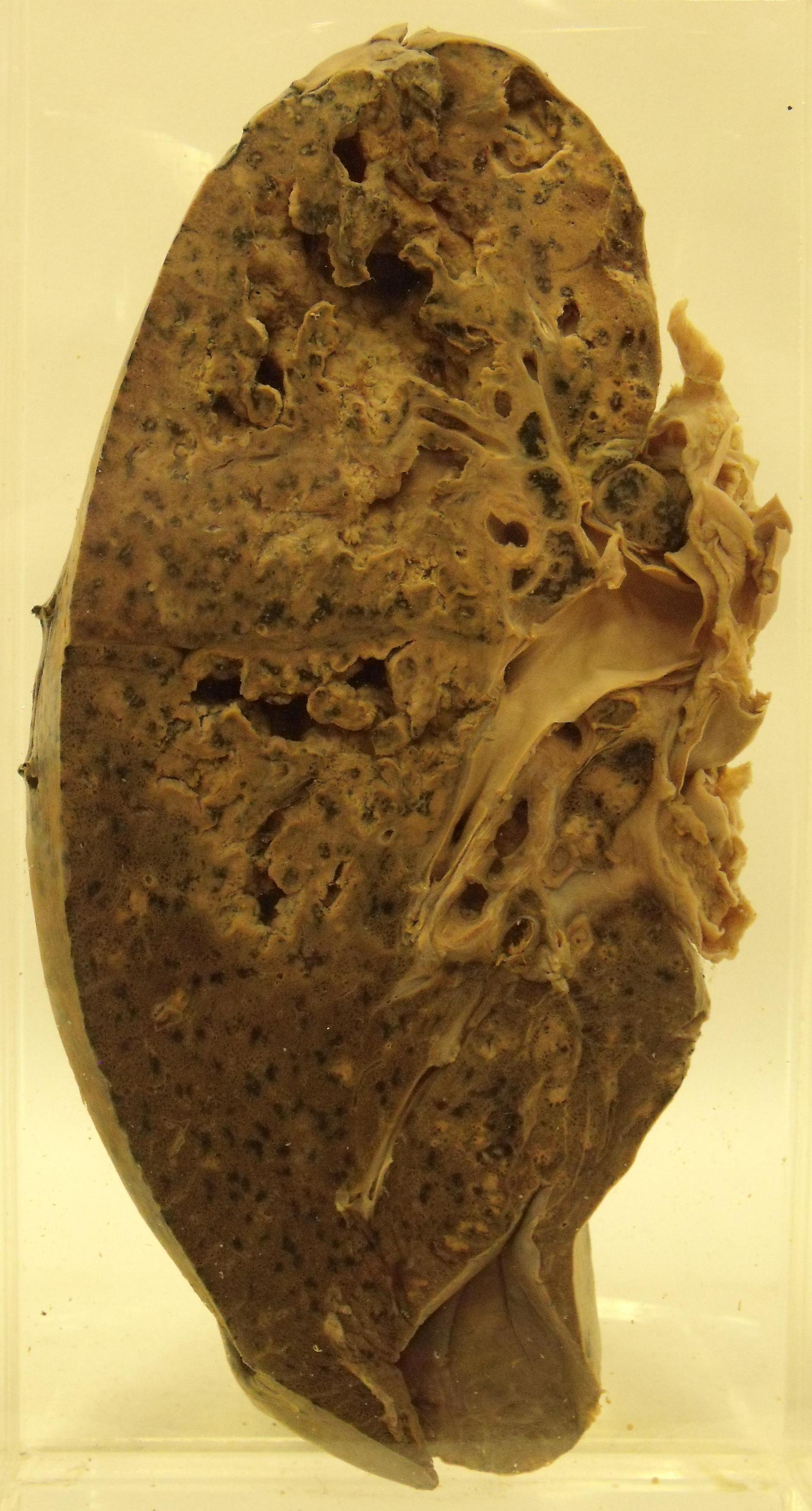Pulmonary tuberculosis