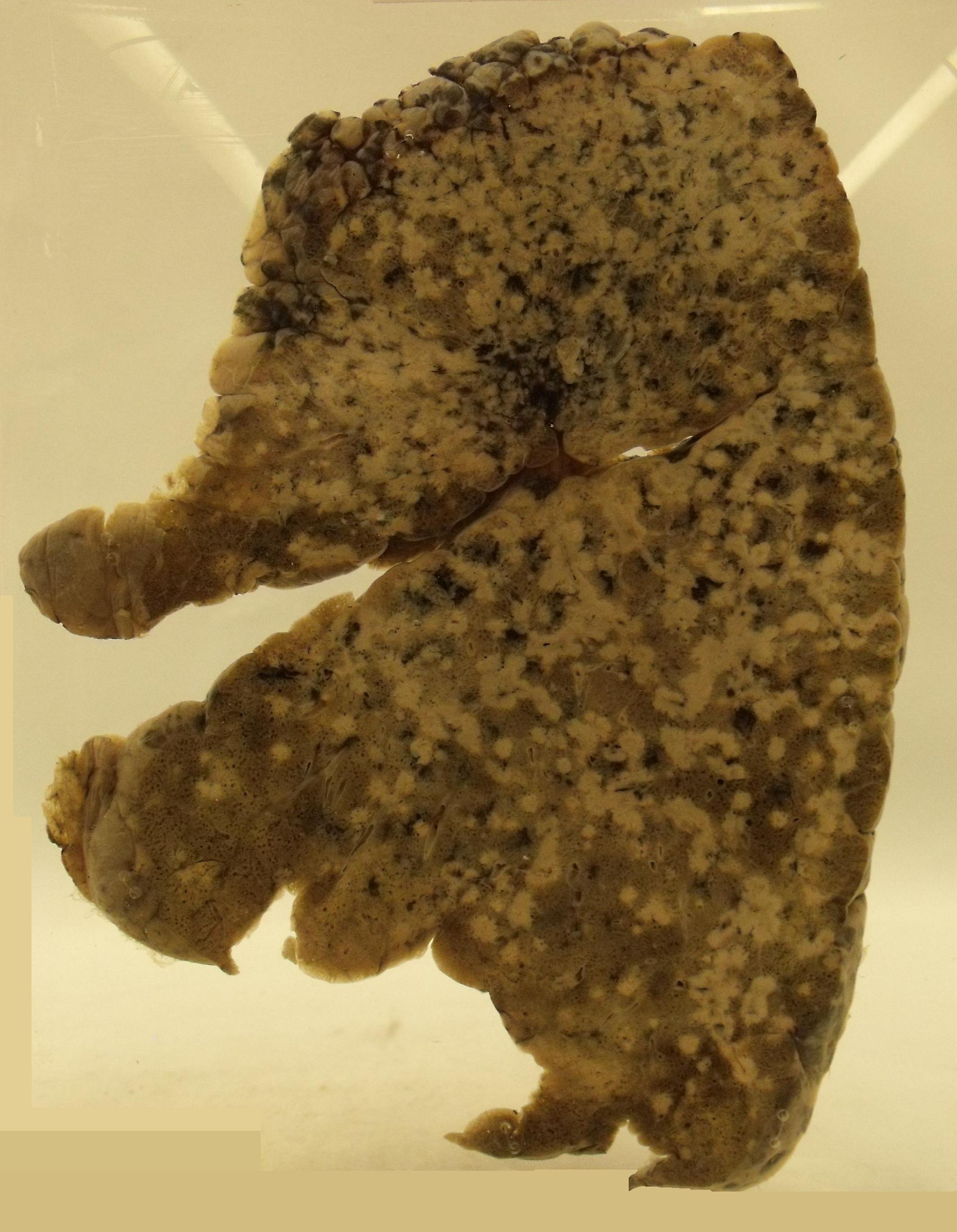 Pulmonary tuberculosis